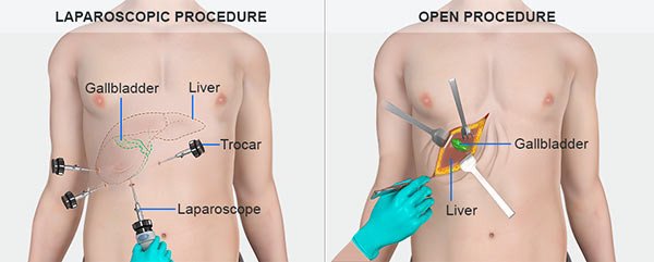 Advanced Laparoscopic Surgery in Jalpaiguri