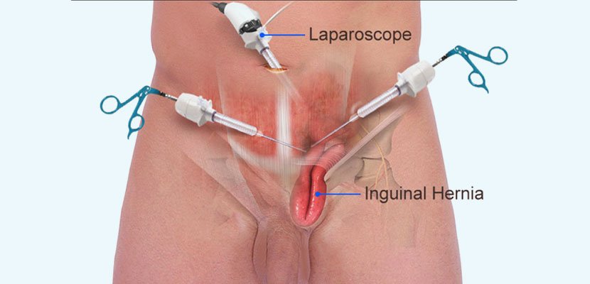 Hernia Surgery in jalpaiguri