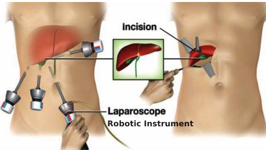 Hernia Surgery in jalpaiguri