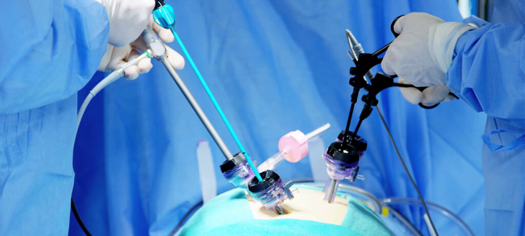 Advanced Laparoscopic Surgery in Jalpaiguri